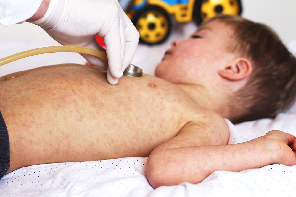 image of child with measles rash beeing looked at by a doctor